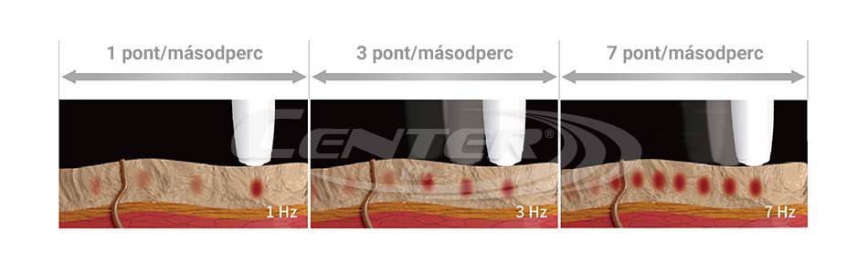 Microson Pen kezelési sebesség